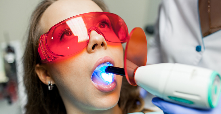 Sbiancamento dentale